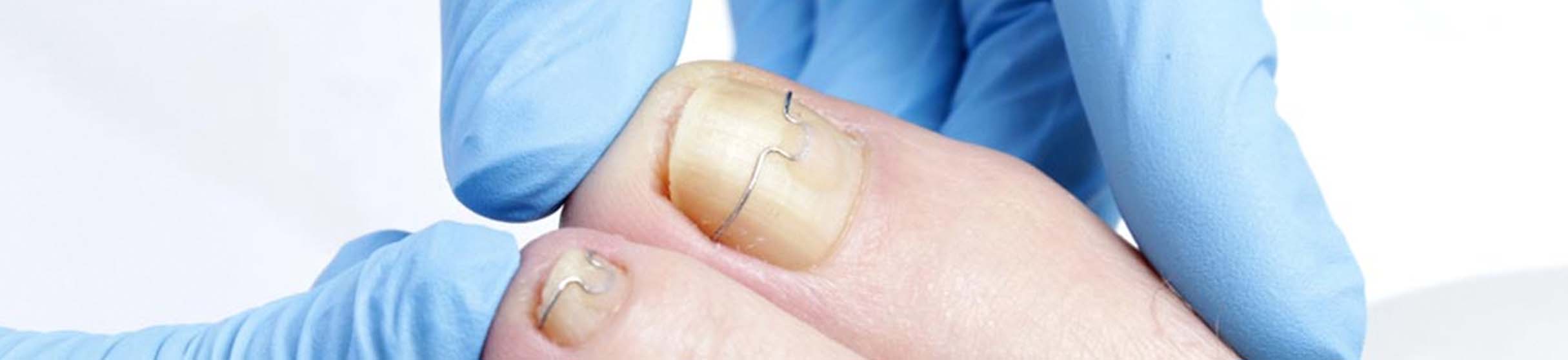 Orthonyxie nagelbeugel