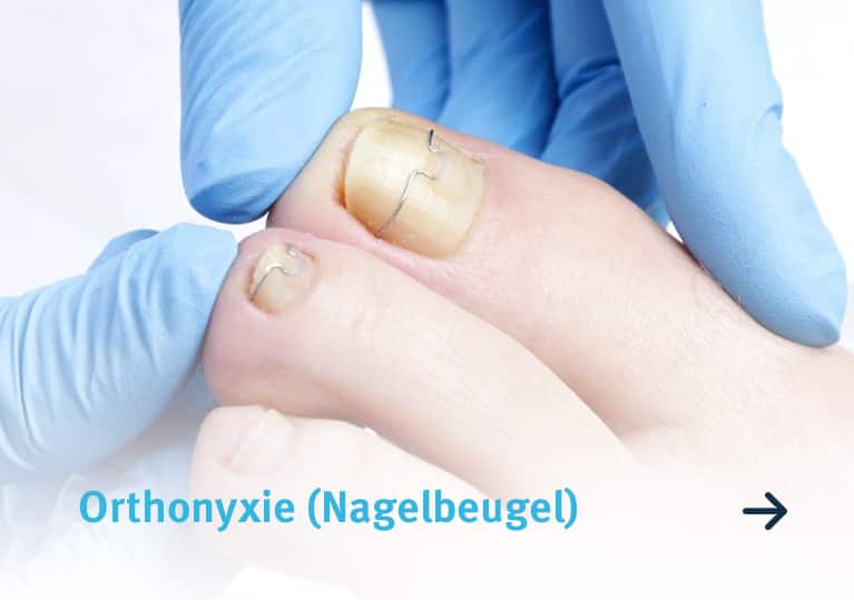 orthonyxie (nagelbeugel)